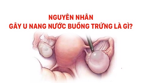 Nguyên nhân gây u nang nước buồng trứng là gì? Xem ngay đáp án tại đây